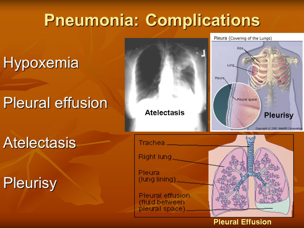 Pneumonia: Complications Hypoxemia Pleural effusion Atelectasis Pleurisy Atelectasis Pleurisy Pleural Effusion